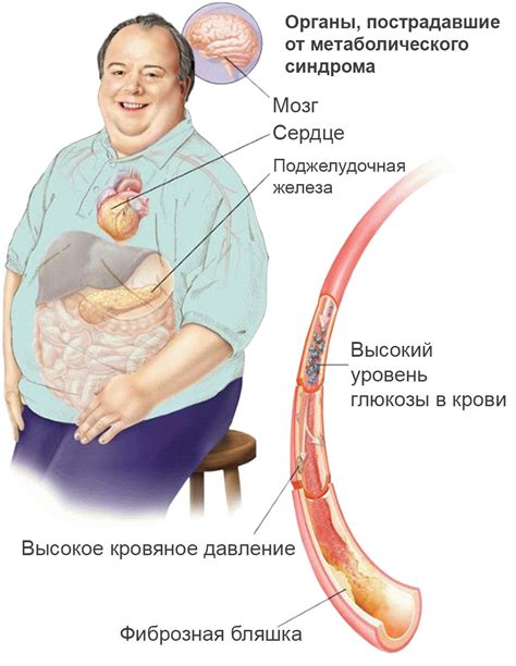 Абдоминальное ожирение и метаболический синдром: связь и риски