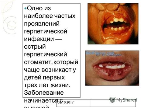 Афтозные язвы: одно из наиболее распространенных проявлений внутриротовых проблем