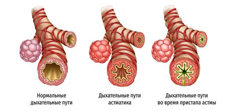 Бронхиальная астма: выявление и терапия