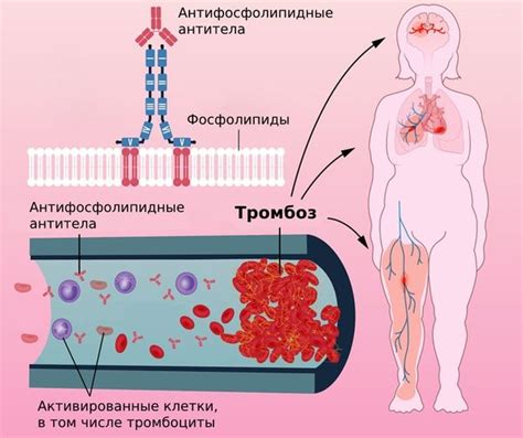 Взаимосвязь волчаночного антикоагулянта и здоровья детей: влияние и значение