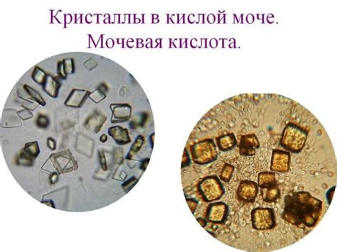 Влияние неопределенных кристаллов в моче на состояние организма