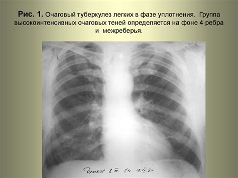 Влияющие факторы и характеристики уплотнения корней легких на рентгеновских снимках