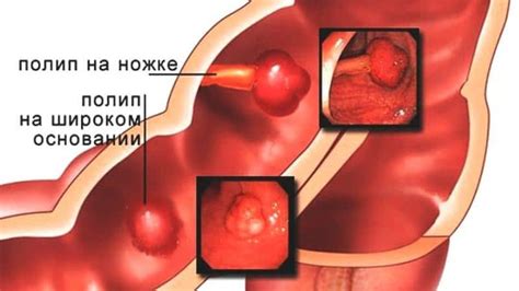 Воздержитесь от привычек, негативно воздействующих на состав микроорганизмов в прямой кишке