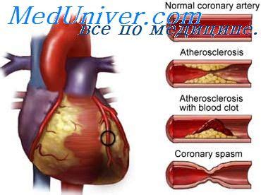Возможные причины нестабильной стенокардии