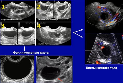 Возможные причины отсутствия обнаружения желтого тела на узи