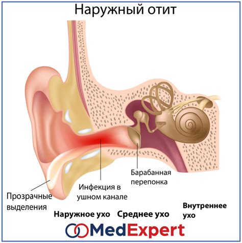 Воспаление наружного слухового прохода