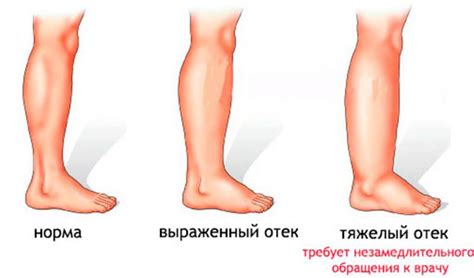 Воспалительные процессы, вызывающие отек в области голени