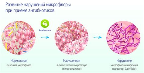 Восстанавление микрофлоры у детей при приеме антибиотиков: роль пробиотиков