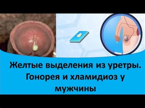 Выделения из уретры