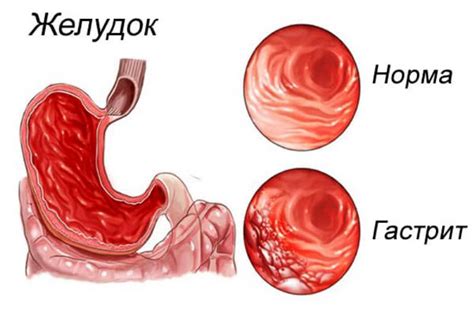 Гастрит: воспаление слизистой оболочки желудка