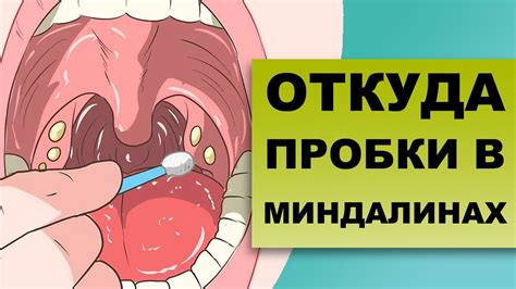 Диагностика наличия гноя в области миндалин при воспалении миндалин