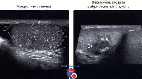 Диагностика отсутствия фолликулов в яичниках на УЗИ