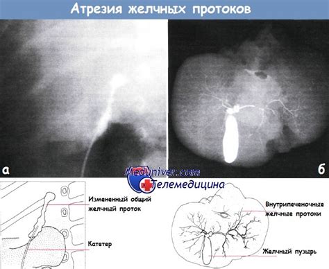 Диагностика патологического изгиба желчных протоков у взрослых