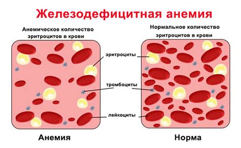 Железодефицитная анемия