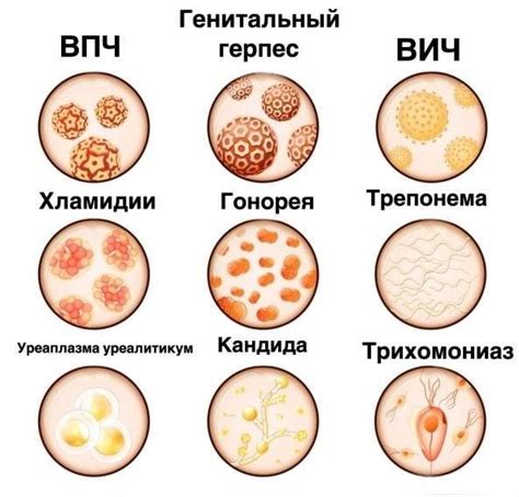 Заболевания влагалища, связанные с онкологическими процессами