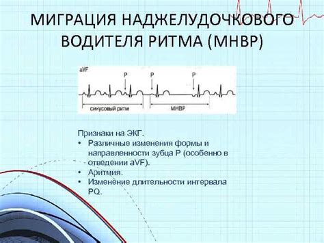 Значение наджелудочкового ритма в кардиограмме