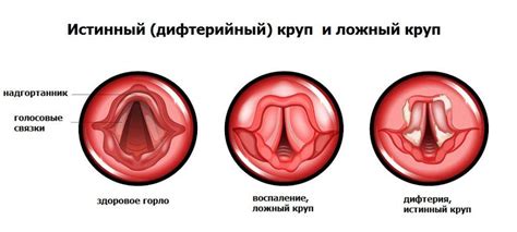 Значимость увлажнения горла у детей