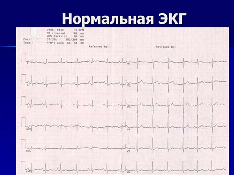 Интерпретация аномалий на ЭКГ