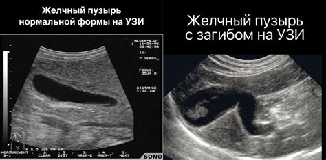 Исследования для установления диагноза при перегибе желчного пузыря у взрослых