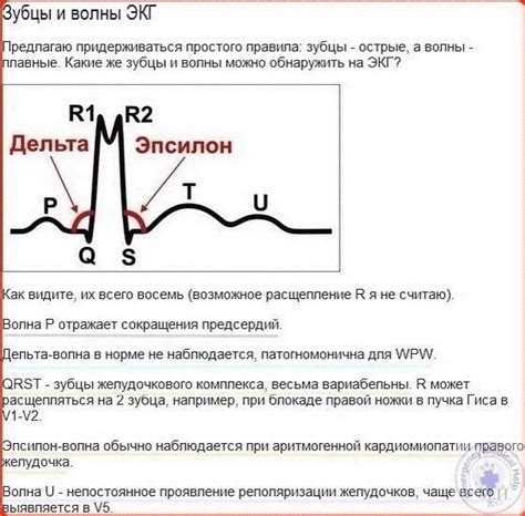 Как выявить отсутствие зубца Р на ЭКГ?