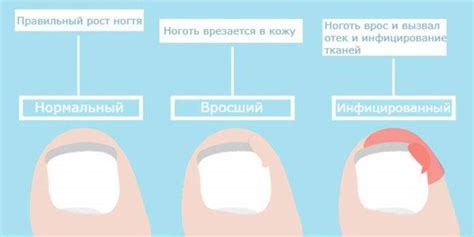 Как удалить бумажный ноготь без вреда для палец