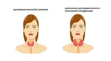 Как уровень гормона тиреотропного стимулирующего гормона (ТТГ) может быть снижен благодаря правильному питанию?