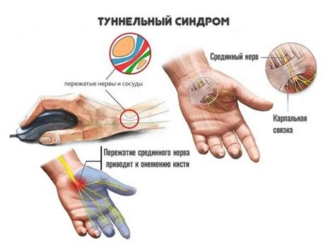 Карпальный туннельный синдром: сжатие нерва и его проявления