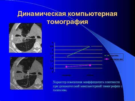 Классификация изменений плотности при компьютерной томографии легких