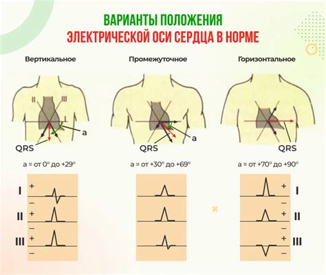 Клиническое значение Эос полувертикальной на ЭКГ и необходимое лечение