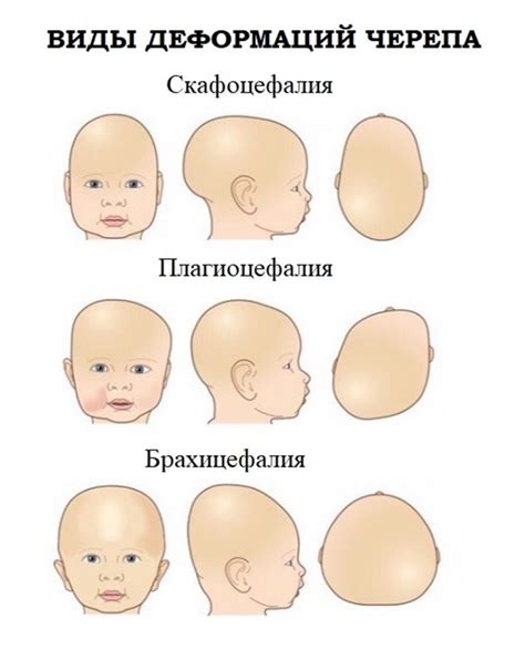 Когда наступает момент, когда необходимо начинать лечение видимых изменений формы головы у младенцев?