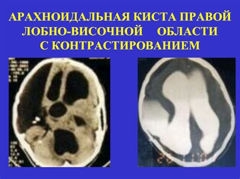 Контроль над общественным поведением: влияние правой лобно-височной области мозга