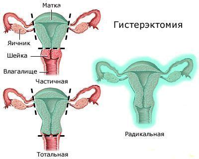 Кто подходит для нервосберегающей экстирпации расширенной матки с придатками?