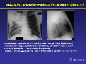 Лечение неравномерной пневматизации легочной паренхимы