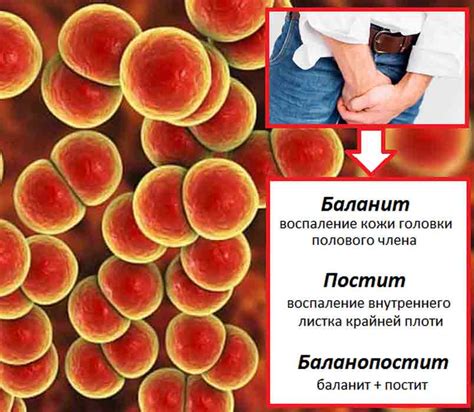 Лечение неспецифического баланопостита