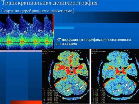 Лечение нетравматического субдурального кровоизлияния