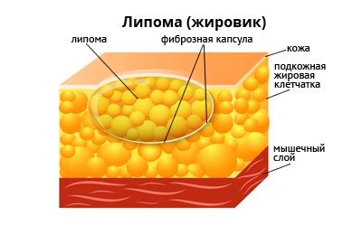 Липома: сущность и происхождение опухоли в области живота