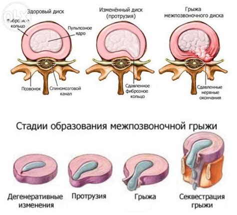 Массаж и другие альтернативные способы облегчения дисковой грыжи