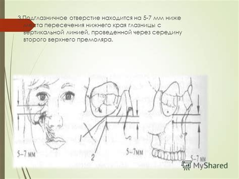 Методика и особенности проведения операции открытого подъема дна околоушной синуса
