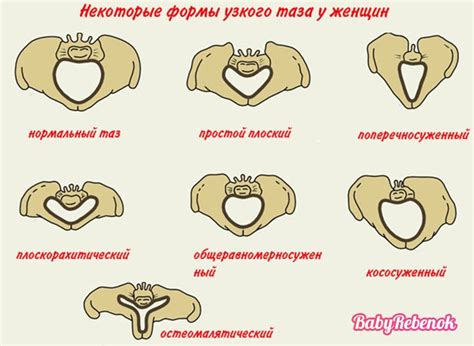 Методы выявления клинически узкого таза