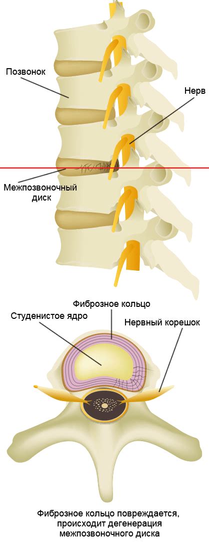 Методы диагностики пролапсов межпозвоночных дисков