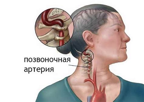 Методы лечения и профилактические меры для предотвращения развития стеноза сосудов шеи