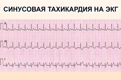 Методы медикаментозного воздействия на низкий сердечный ритм при повышенном кровяном давлении