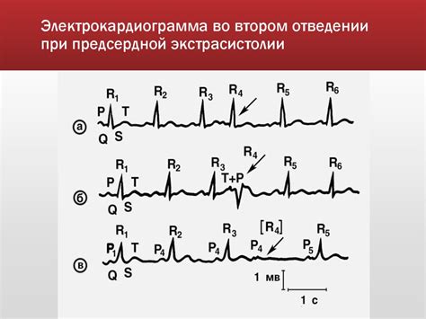 Механизмы парной предсердной экстрасистолии: что происходит в организме