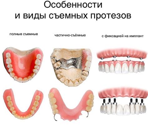 Мостовидные протезы: альтернатива имплантации для восстановления утраченных зубов