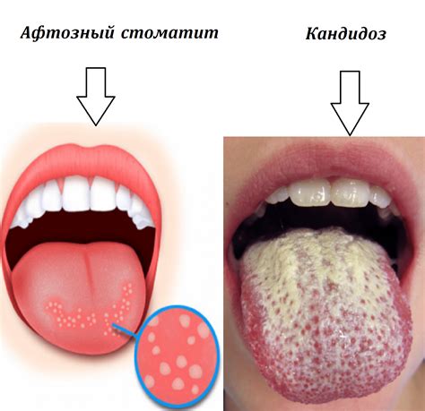 Нарушения ротовой полости как основная причина ощущения жжения во рту