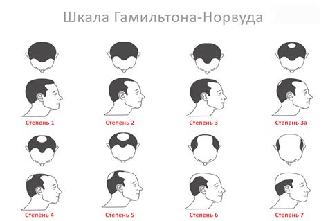 Наследственность в качестве главного фактора возникновения областей облысения