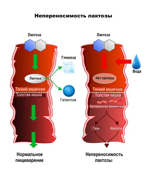 Непереносимость лактозы и грудничковый диареальный генез