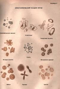 Неподдающиеся классификации кристаллы в моче: происхождение и важность