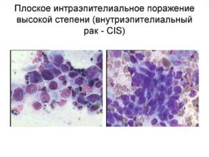 Обзор интраэпителиального поражения высокой степени