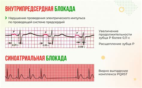 Обнаружение внутрипредсердной блокады 1 степени при ЭКГ и ее интерпретация